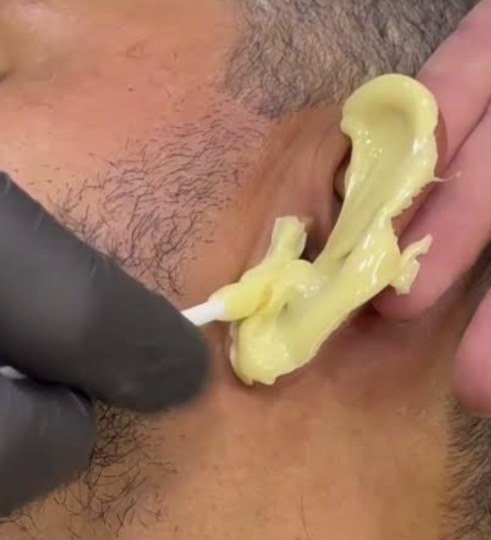 Epilação Auricular